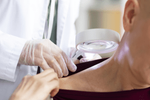 skin cancer